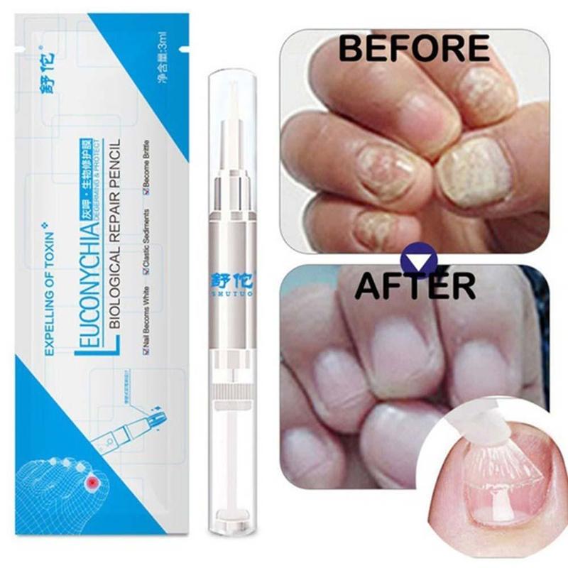 Pluma para tratamiento de hongos en las uñas, solución de reparación biológica antihongos, aceite nutritivo de 3ml, restaura las uñas de los pies saludables, 1 Uds.