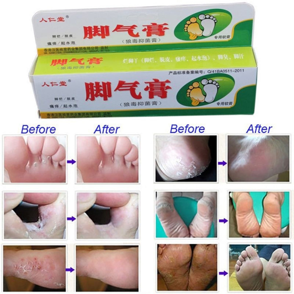 25g Foot Care Cream Athlete's Itch Blisters Peeling Beriberi Bad Feet Ointment